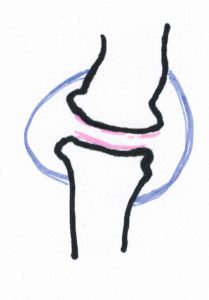 Gewricht met arthrose. Roze = kraakbeen, dunner, paars = kapsel. 